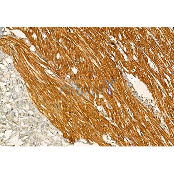 Phospho-IRE1 (Ser724) Antibody - AF7150 at 1/100 staining Human pancreatic cancer by IHC-P.