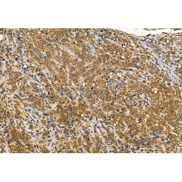 Phospho-IRE1 (Ser724) Antibody - AF7150 at 1/100 staining Human normal tissues adjacent to lung cancer by IHC-P.