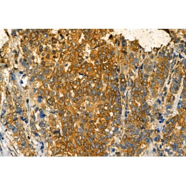Phospho-IRE1 (Ser724) Antibody - AF7150 at 1/100 staining Human mammary cancer by IHC-P.