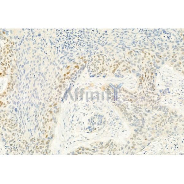 Phospho-CDK4 (Thr172) Antibody - AF8007 at 1/100 staining Human lung cancer by IHC-P.