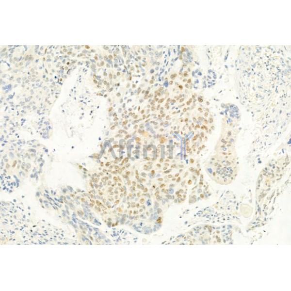 Phospho-CDK4 (Thr172) Antibody - AF8007 at 1/100 staining Human lung cancer by IHC-P.