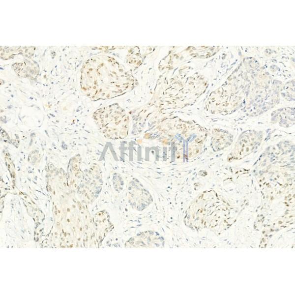 Phospho-CDK4 (Thr172) Antibody - AF8007 at 1/100 staining Human esophageal cancer by IHC-P.