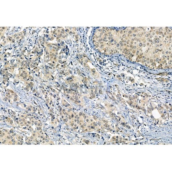 Phospho-Smad3 (Ser423+Ser425) Antibody - AF8315 at 1/100 staining Human mammary cancer by IHC-P.