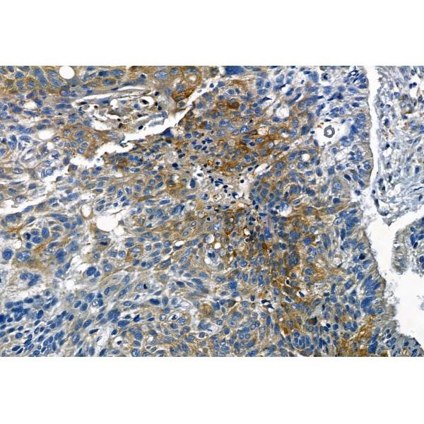 Phospho-TGFBR1 (Thr204) Antibody - AF8456 at 1/100 staining Human lung cancer by IHC-P.