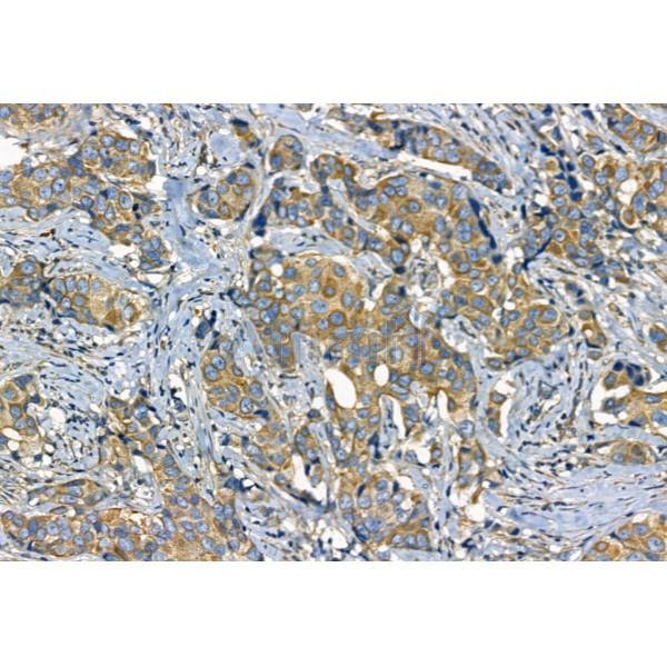 Phospho-TGFBR1 (Thr204) Antibody - AF8456 at 1/100 staining Human mammary cancer by IHC-P.