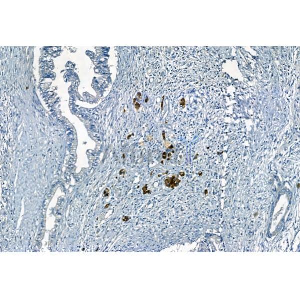 APOBEC3A Antibody - AF9009 at 1/100 staining Human pancreatic cancer by IHC-P.