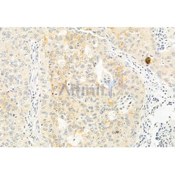 GADD34 Antibody - DF12009 at 1/100 staining Human lung cancer by IHC-P.