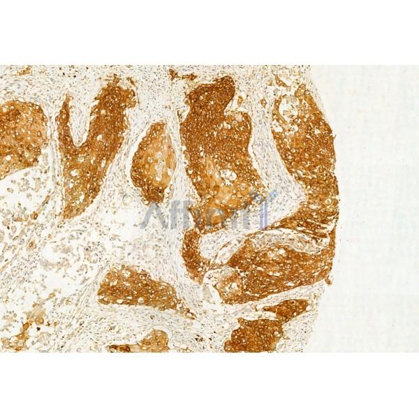 IFT20 Antibody - DF12014 at 1/100 staining Human esophageal cancer by IHC-P.