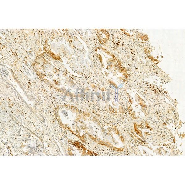 IFT20 Antibody - DF12014 at 1/100 staining Human pancreatic cancer by IHC-P.