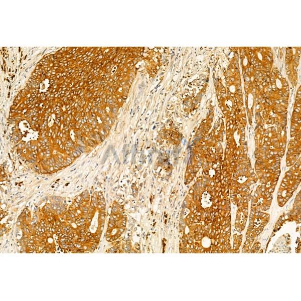 IFT20 Antibody - DF12014 at 1/100 staining Human colorectal cancer by IHC-P.