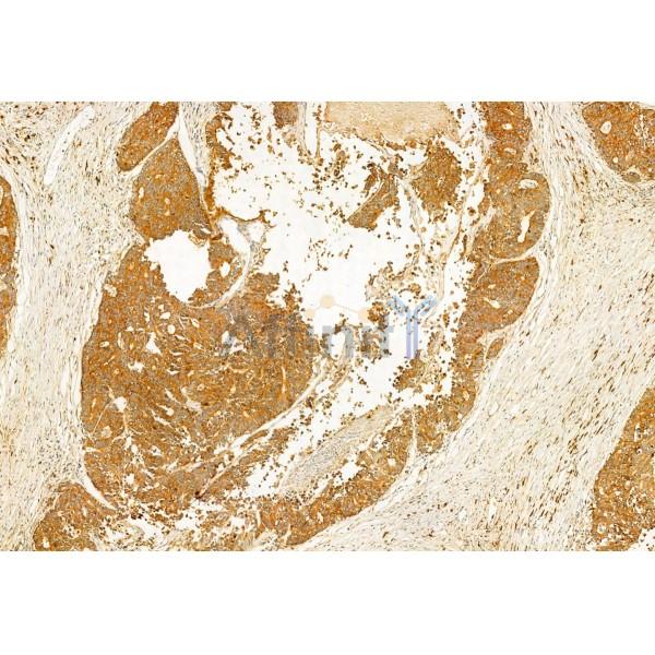 IFT20 Antibody - DF12014 at 1/100 staining Human colorectal cancer by IHC-P.