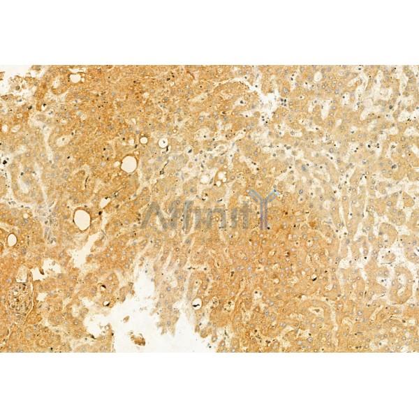 TCTN1 Antibody - DF12029 at 1/100 staining Human esophageal cancer by IHC-P.