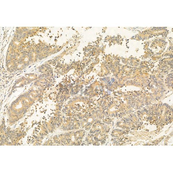 BBS5 Antibody - DF12030 at 1/100 staining Human colorectal cancer by IHC-P.