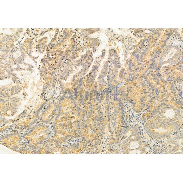BBS5 Antibody - DF12030 at 1/100 staining Human lung cancer by IHC-P.