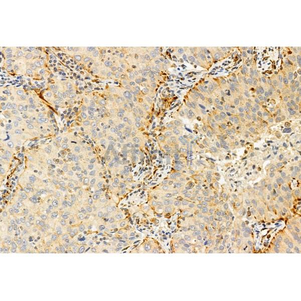 IFT81 Antibody - DF12032 at 1/100 staining Human lung cancer by IHC-P.