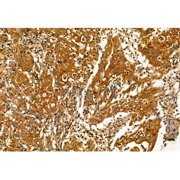 PLDN Antibody - DF12041 at 1/100 staining Human gastric cancer by IHC-P.
