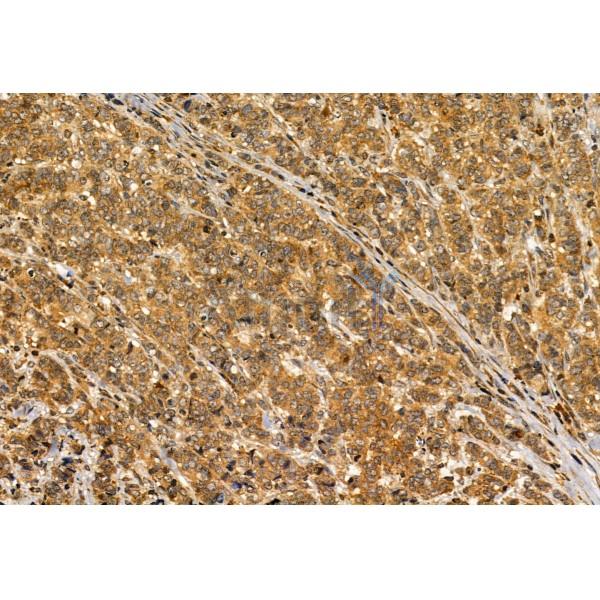 S100A14 Antibody - DF12042 at 1/100 staining Human mammary cancer by IHC-P.