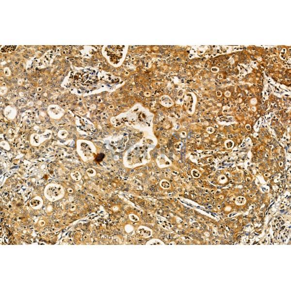 S100A14 Antibody - DF12042 at 1/100 staining Human gastric cancer by IHC-P.