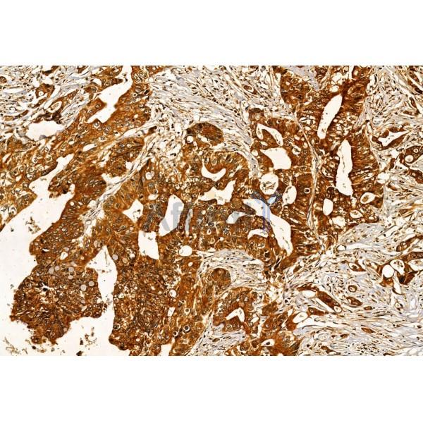 SEC5/EXOC2 Antibody - DF12043 at 1/100 staining Human colorectal cancer by IHC-P.