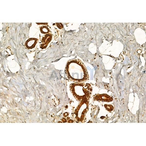 SEC5/EXOC2 Antibody - DF12043 at 1/100 staining Human liver cancer by IHC-P.