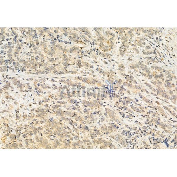 AIMP2/p38 Antibody - DF12048 at 1/100 staining Human mammary cancer by IHC-P.