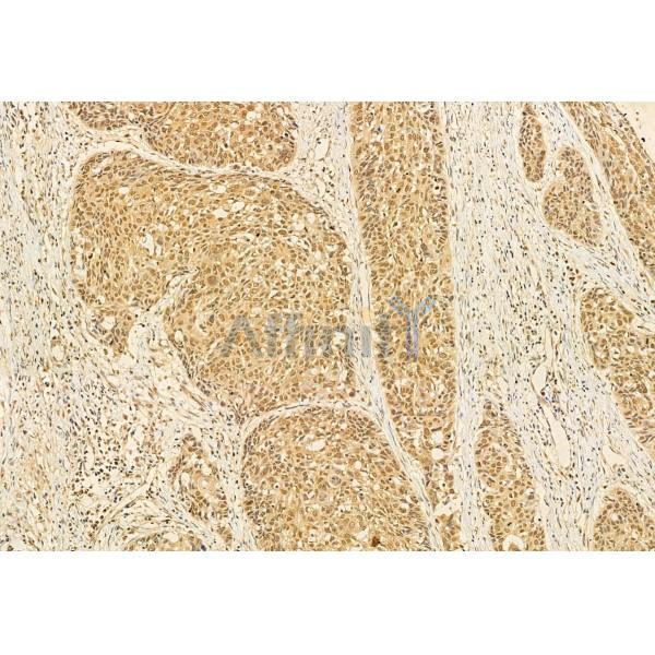 AIMP2/p38 Antibody - DF12048 at 1/100 staining Human normal tissues adjacent to esophageal cancer by IHC-P.