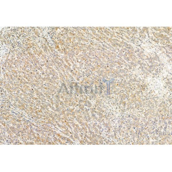 PPP1R15B Antibody - DF12050 at 1/100 staining Human mammary cancer by IHC-P.