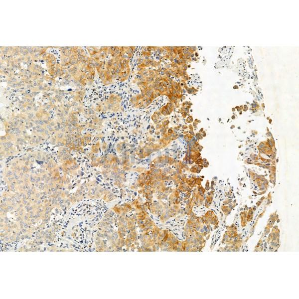 PPP1R15B Antibody - DF12050 at 1/100 staining Human lung cancer by IHC-P.