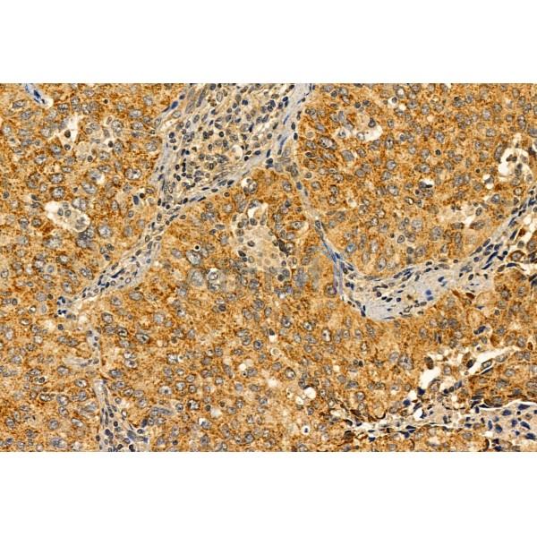 PYCR1 Antibody - DF12051 at 1/100 staining Human lung cancer by IHC-P.