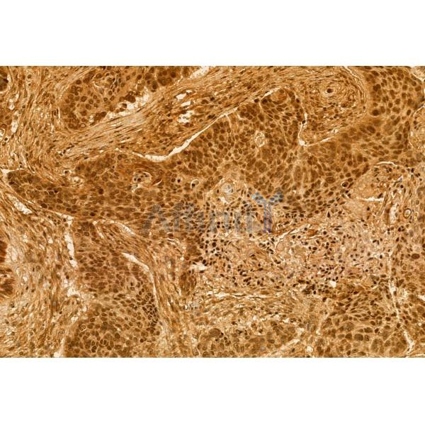 RBM15 Antibody - DF12061 at 1/100 staining Human lung cancer by IHC-P.