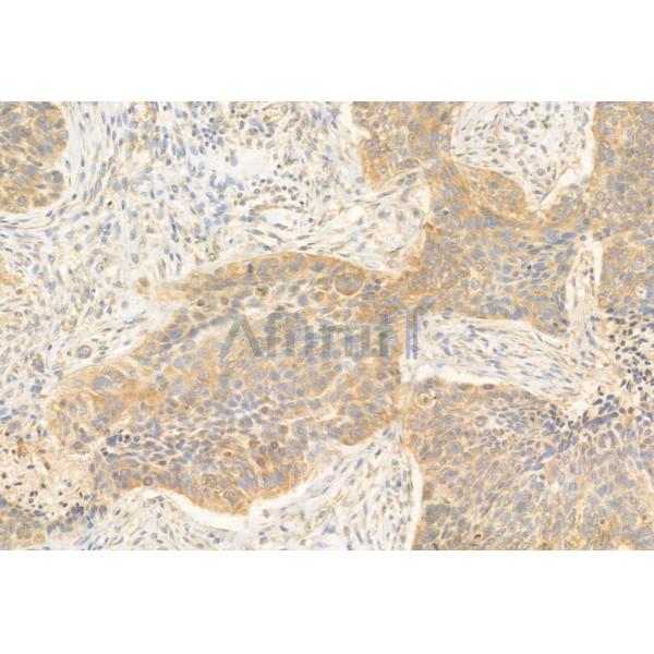 REEP5 Antibody - DF12062 at 1/100 staining Human lung cancer by IHC-P.