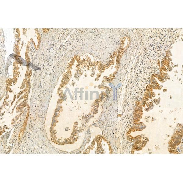 UBAP1 Antibody - DF12064 at 1/100 staining Human pancreatic cancer by IHC-P.