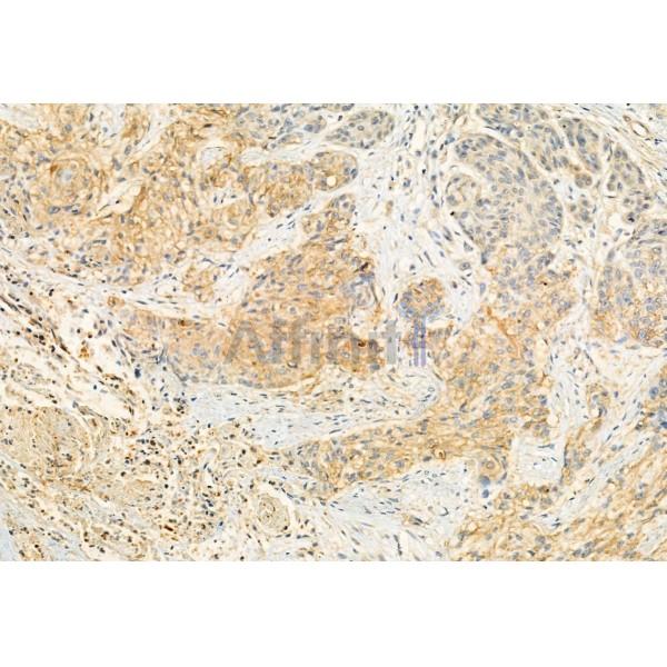 ERAL1 Antibody - DF12072 at 1/100 staining Human esophageal cancer by IHC-P.