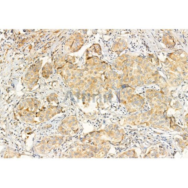 ERAL1 Antibody - DF12072 at 1/100 staining Human mammary cancer by IHC-P.