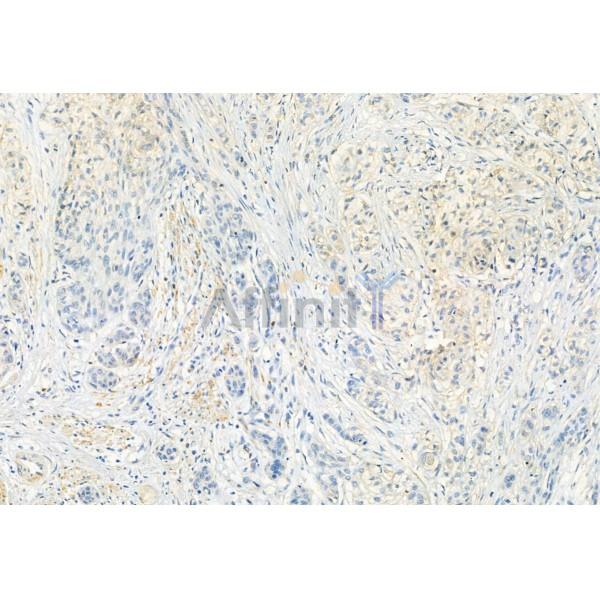 FKBP65 Antibody - DF12073 at 1/100 staining Human esophageal cancer by IHC-P.