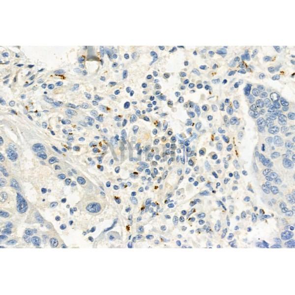 FKBP65 Antibody - DF12073 at 1/100 staining Human lung cancer by IHC-P.