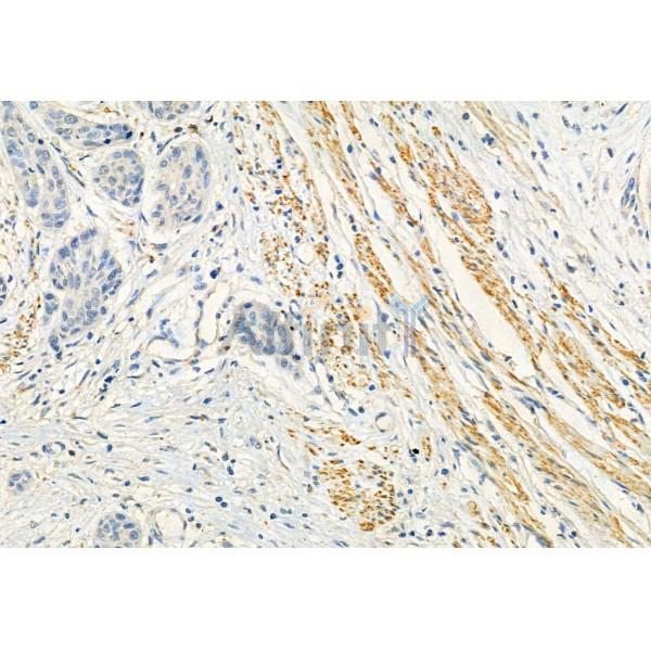 FKBP65 Antibody - DF12073 at 1/100 staining Human esophageal cancer by IHC-P.