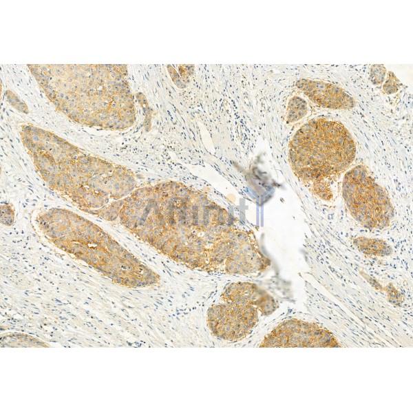 HEPACAM Antibody - DF12075 at 1/100 staining Human normal tissues adjacent to esophageal cancer by IHC-P.
