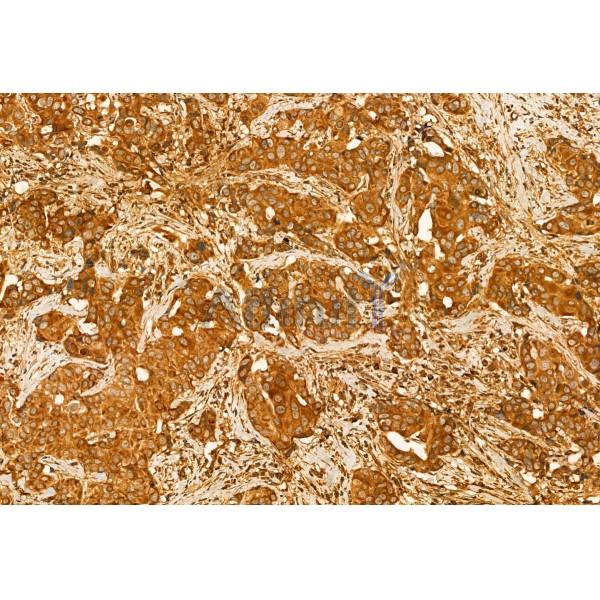 Centrin 1 Antibody - DF12095 at 1/100 staining Human mammary cancer by IHC-P.