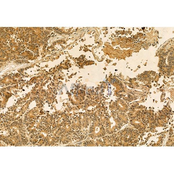 Quiescin Q6 Antibody - DF12104 at 1/100 staining Human normal tissues adjacent to colorectal cancer by IHC-P.
