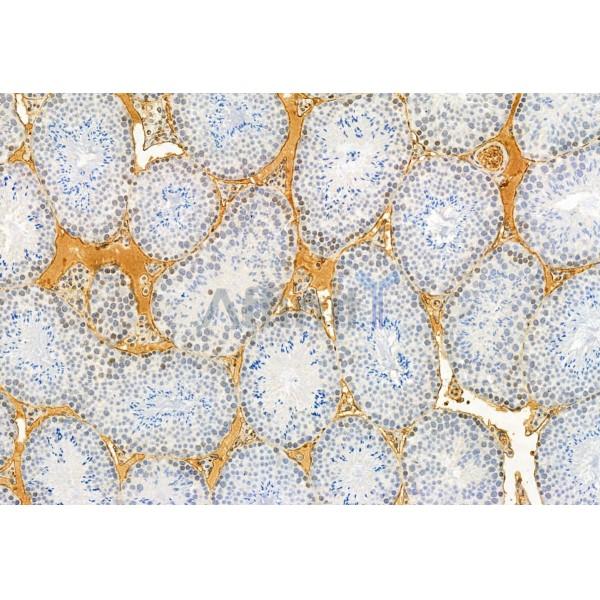 AGGF1 Antibody - DF12109 at 1/100 staining Human gastric cancer by IHC-P.