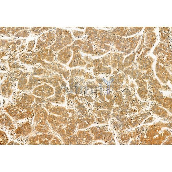 C9orf72 Antibody - DF12112 at 1/100 staining Human liver cancer by IHC-P.