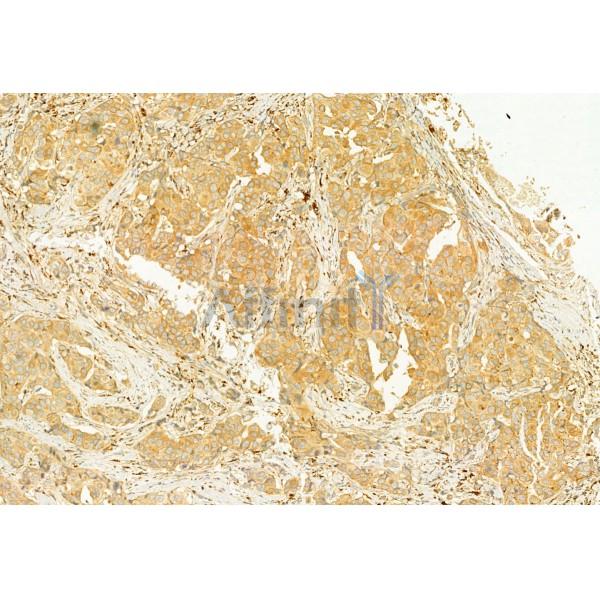 Osteocalcin Antibody - DF12303 at 1/100 staining Human mammary cancer by IHC-P.