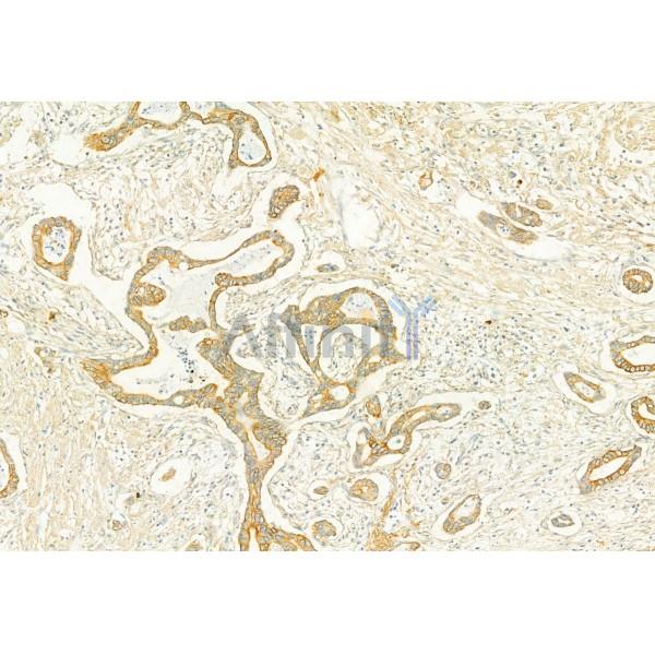 PLCE1 Antibody - DF2565 at 1/100 staining Human pancreatic cancer by IHC-P.