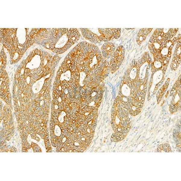 PLCE1 Antibody - DF2565 at 1/100 staining Human colorectal cancer by IHC-P.