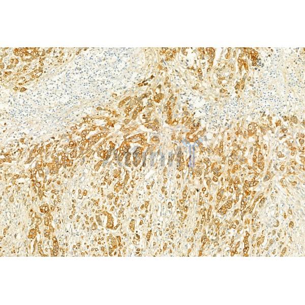 PLCE1 Antibody - DF2565 at 1/100 staining Human gastric cancer by IHC-P.