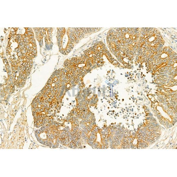 PLCE1 Antibody - DF2565 at 1/100 staining Human colorectal cancer by IHC-P.