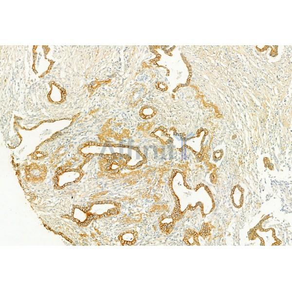PLCE1 Antibody - DF2565 at 1/100 staining Human pancreatic cancer by IHC-P.