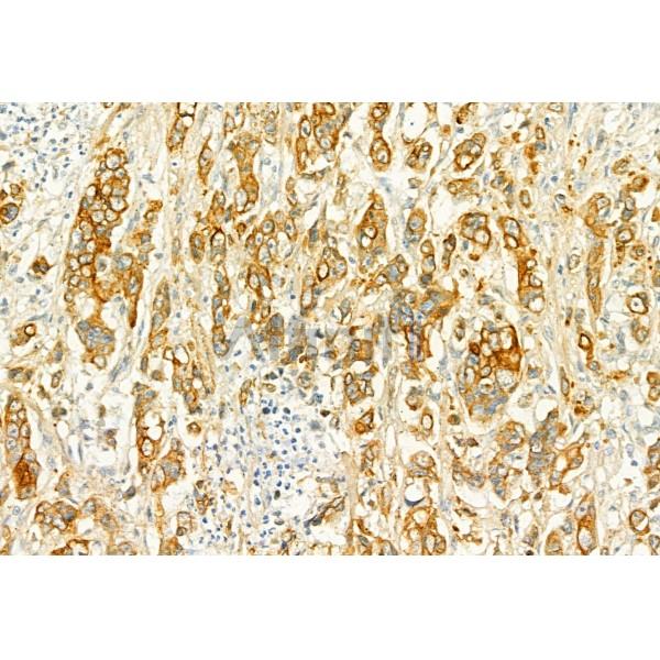 PLCE1 Antibody - DF2565 at 1/100 staining Human gastric cancer by IHC-P.