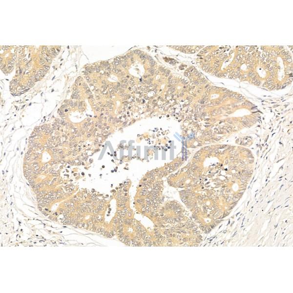SirT1 Antibody - DF6033 at 1/100 staining Human colorectal cancer by IHC-P.